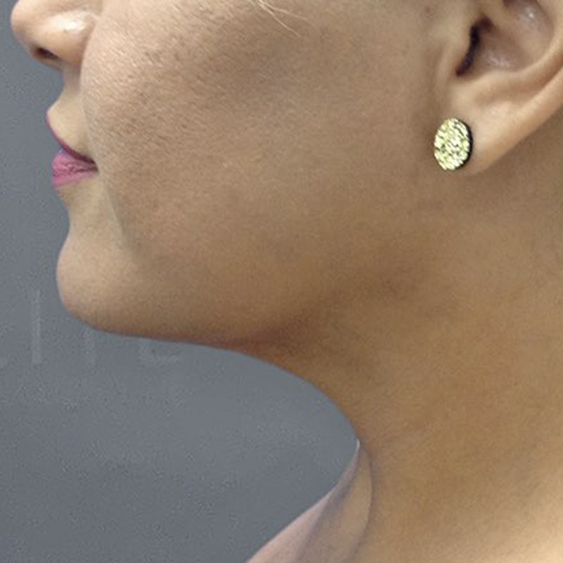 Chin Fat Removal After 2