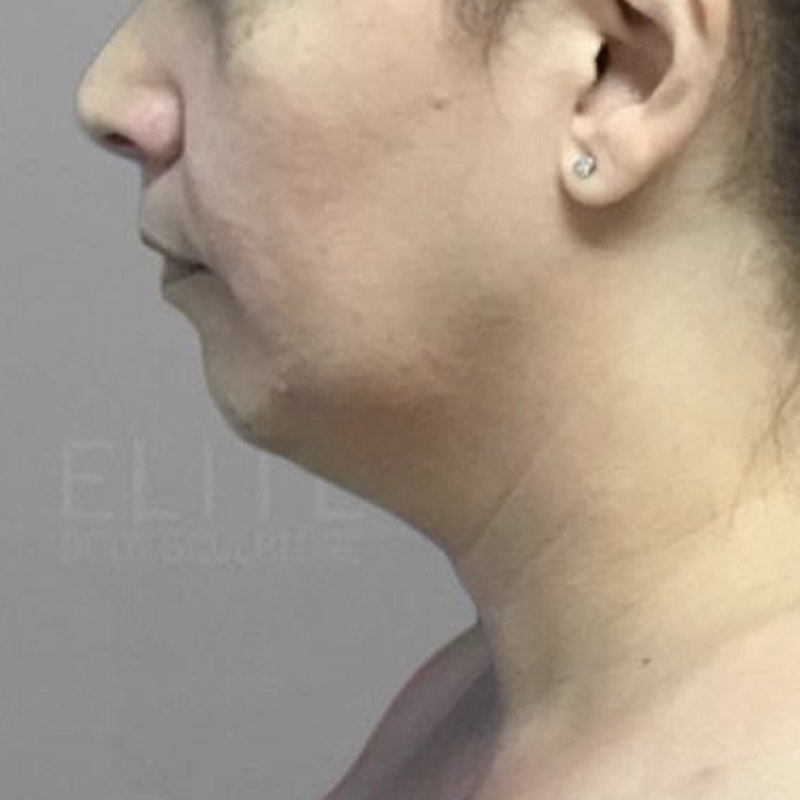 Chin Fat Removal Before 3
