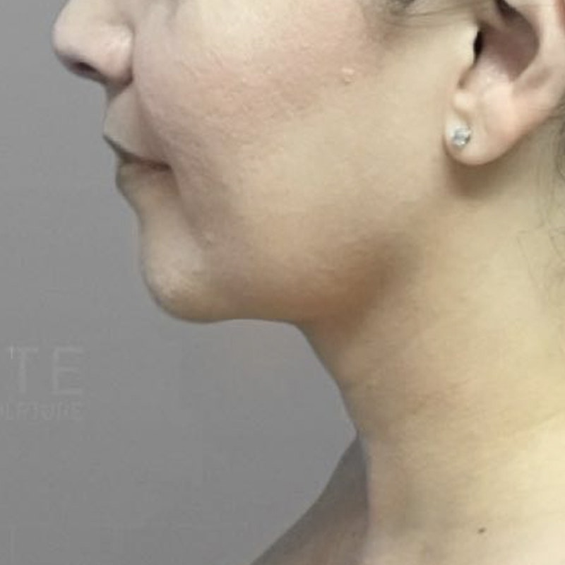 Chin Fat Removal After 3