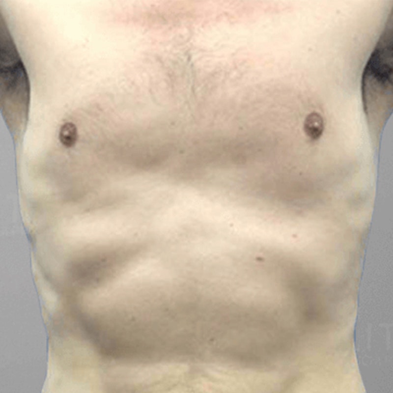 Gynecostmastia After