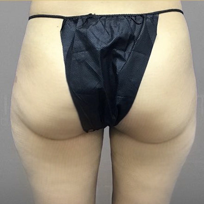 Thigh Fat Removal Before