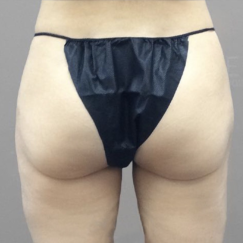 Thigh Fat Removal After