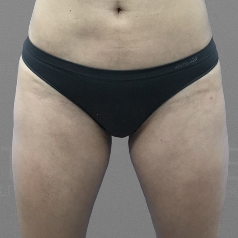 Thigh Fat Removal After 3