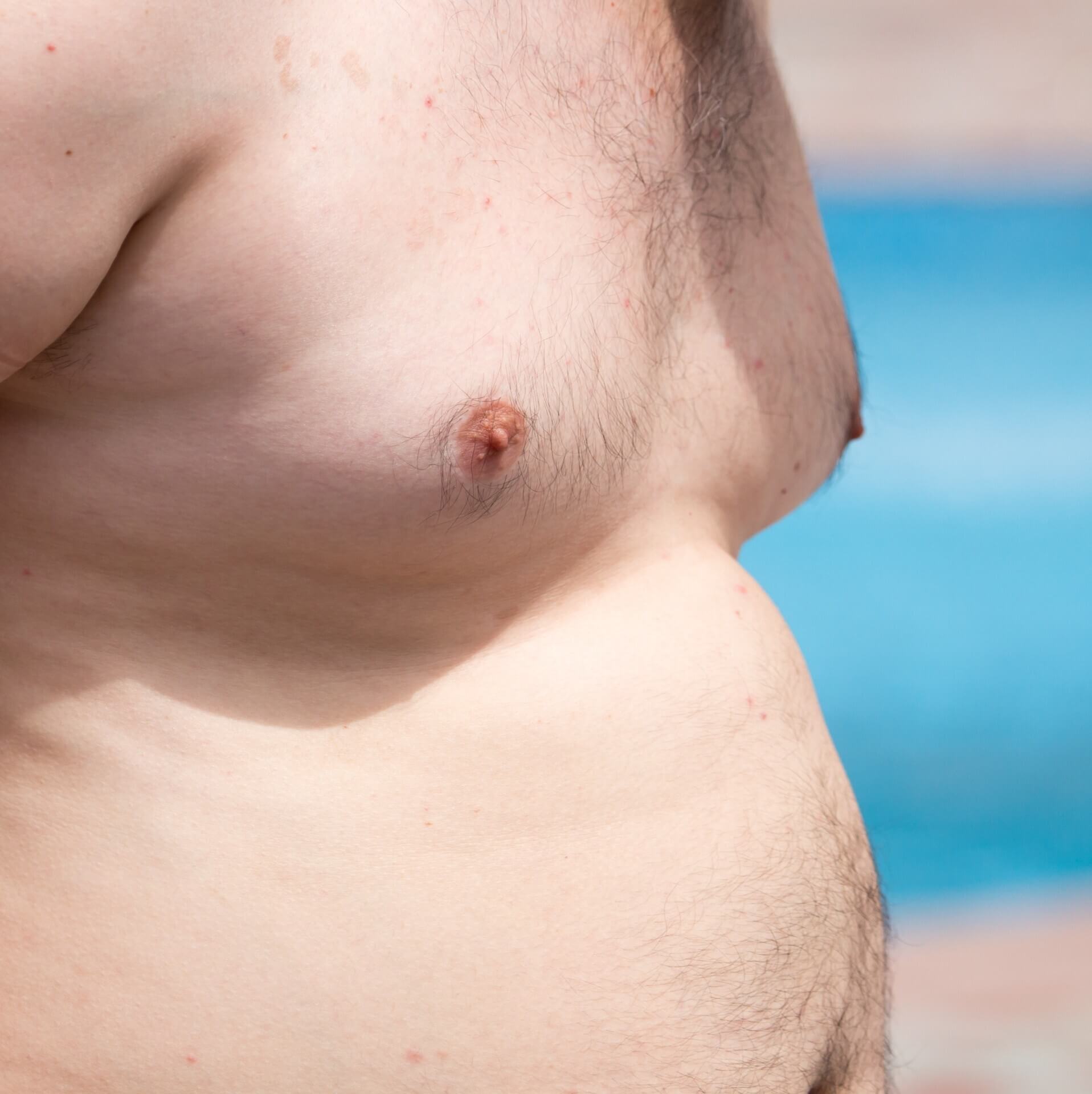 Gynecomastia vs