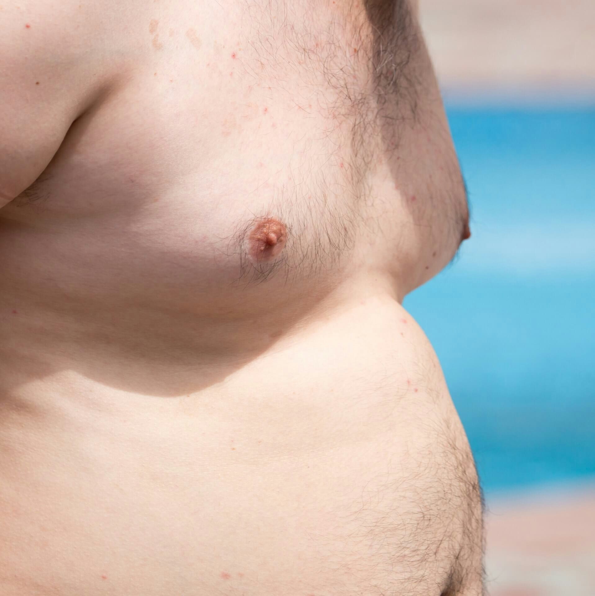 Gynecomastia vs. Chest Fat: What Are the Causes and How Do I Treat