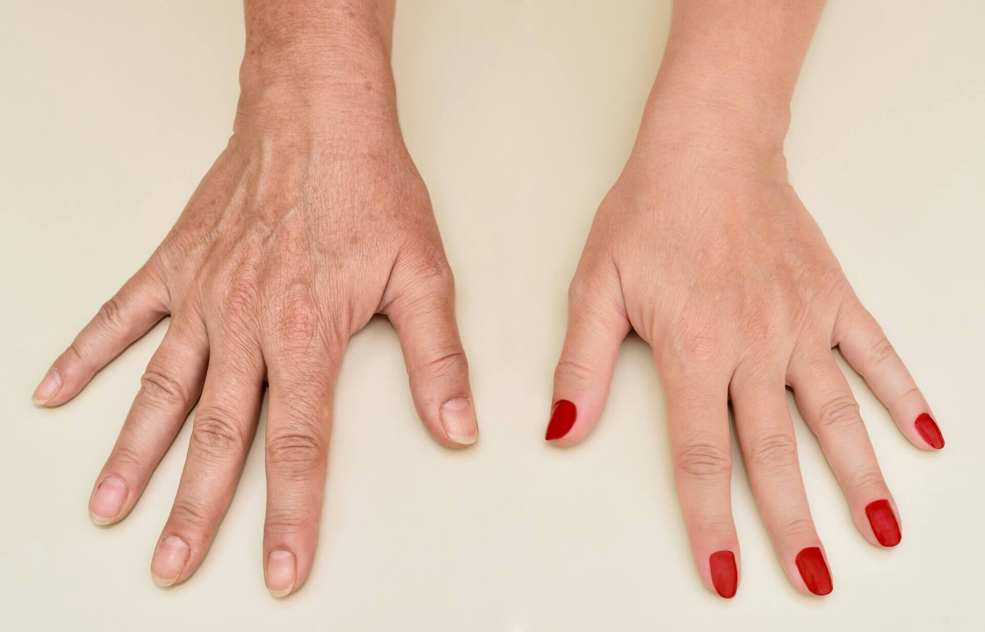 hand rejuvenation