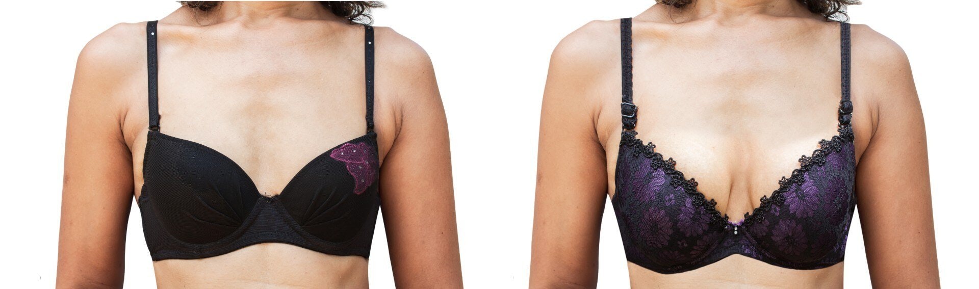 Breast before and after augmentation