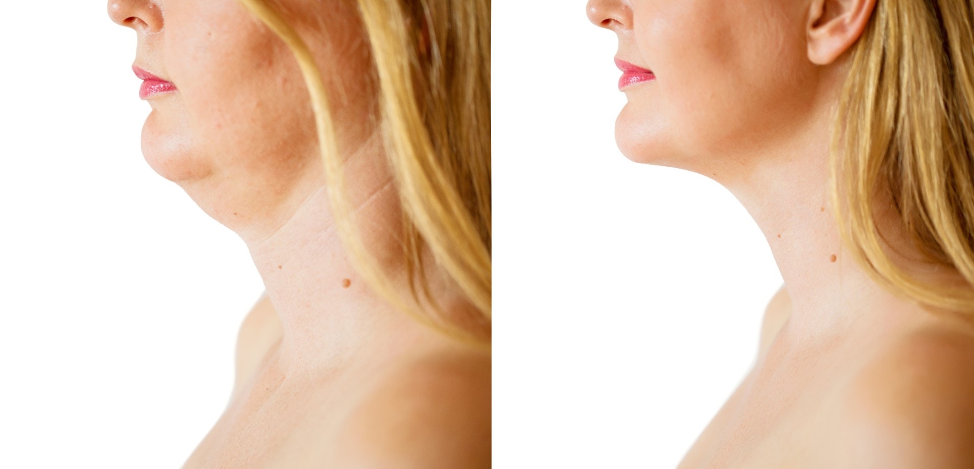 Woman before and after double chin removal
