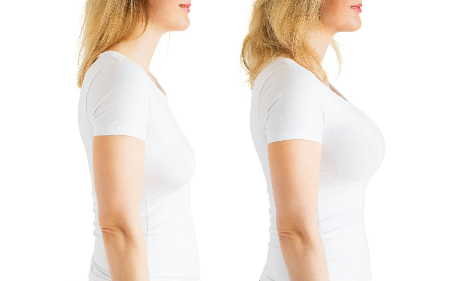 Woman before and after breast augmentation