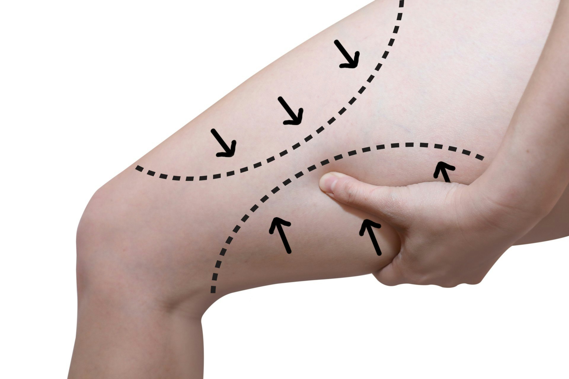 Marked Thigh