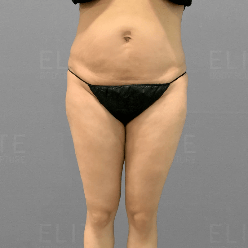 Before Stomach