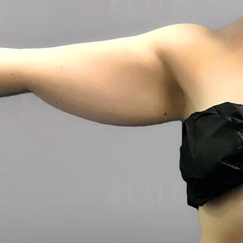 arm before