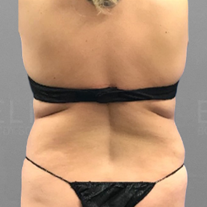 Lower back fat removal before