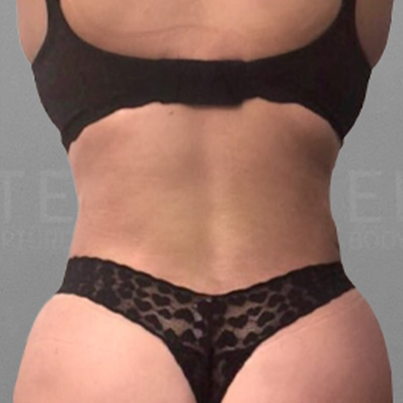 Lower back fat removal after 