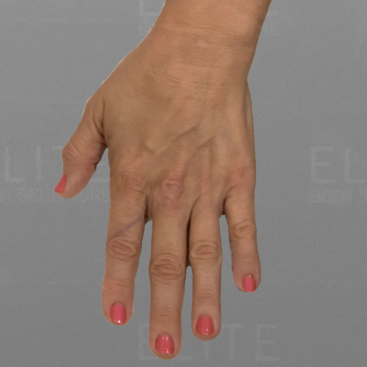 hand airsculpt before