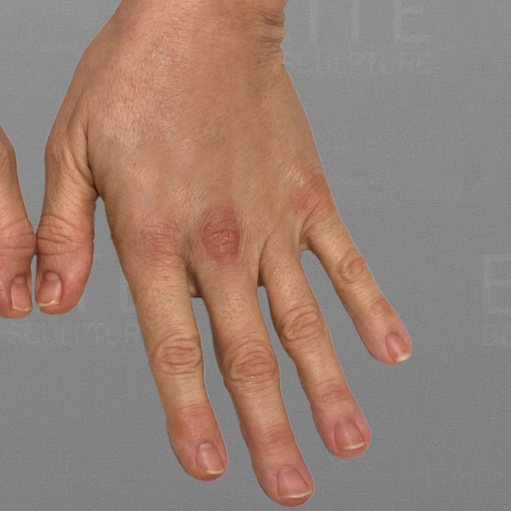 hand airsculpt after