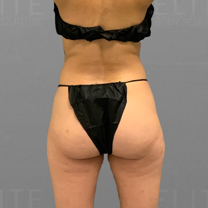 AirSculpt BBL Before