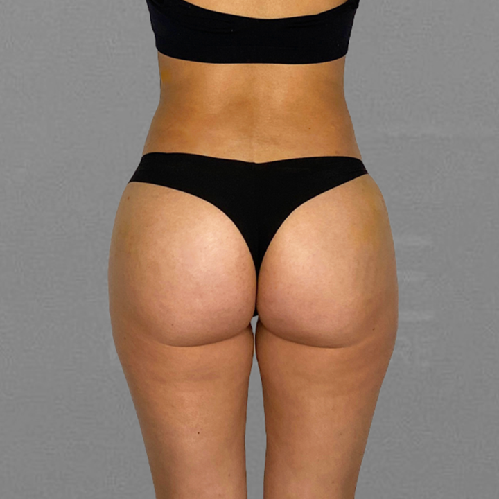 AirSculpt BBL After
