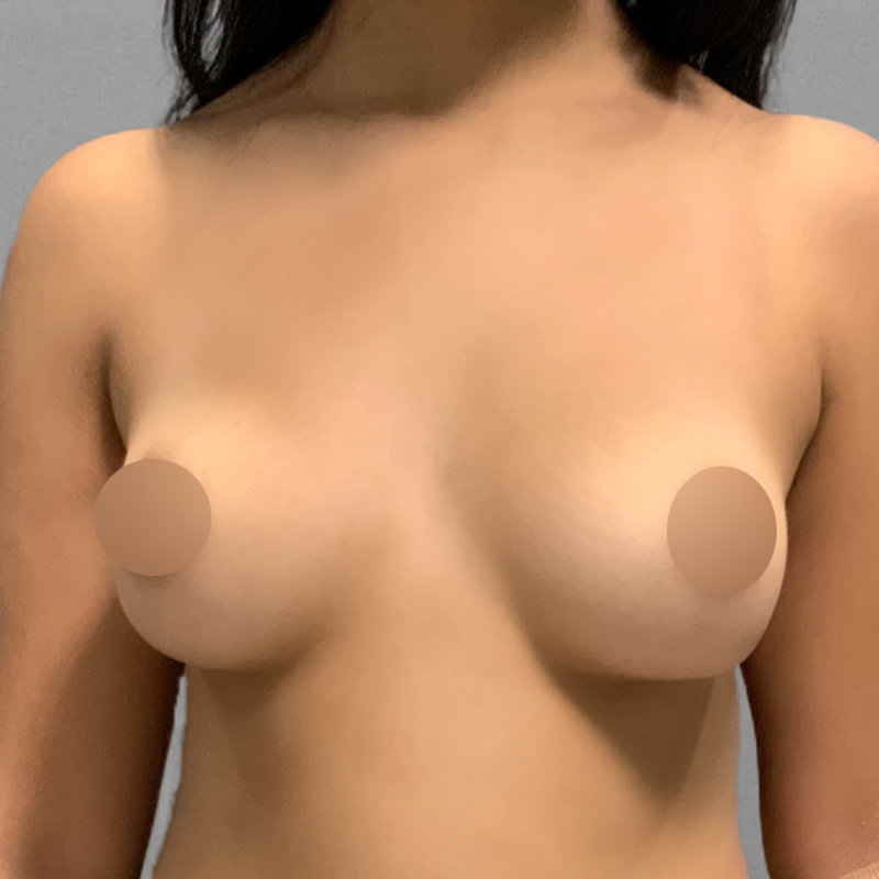 AirSculpt Breast Enhancement Before