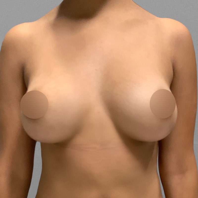 AirSculpt Breast Enhancement After