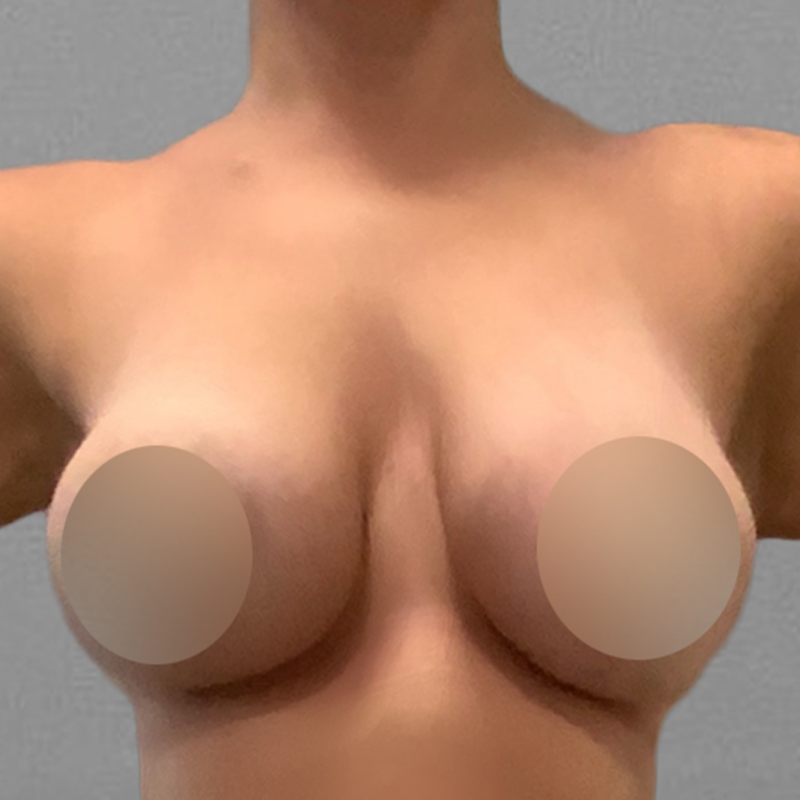 AirSculpt Breast Enhancement After