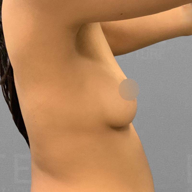 AirSculpt Breast Enhancement Before