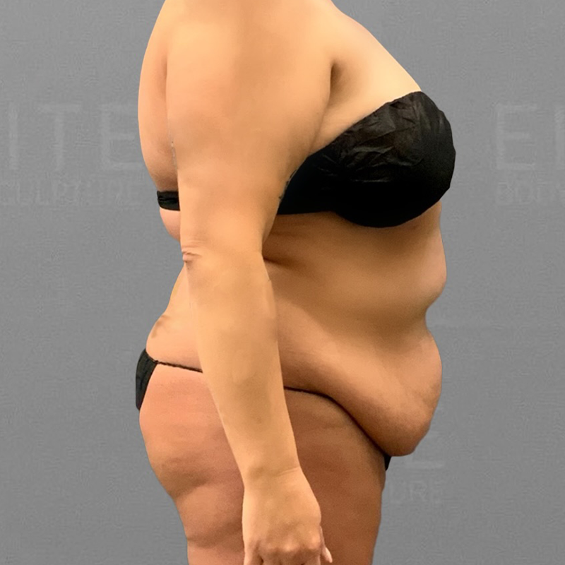 Tiny Tuck Before