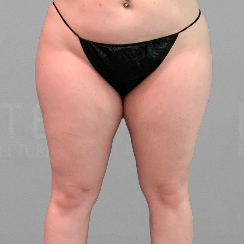 leg airsculpt before