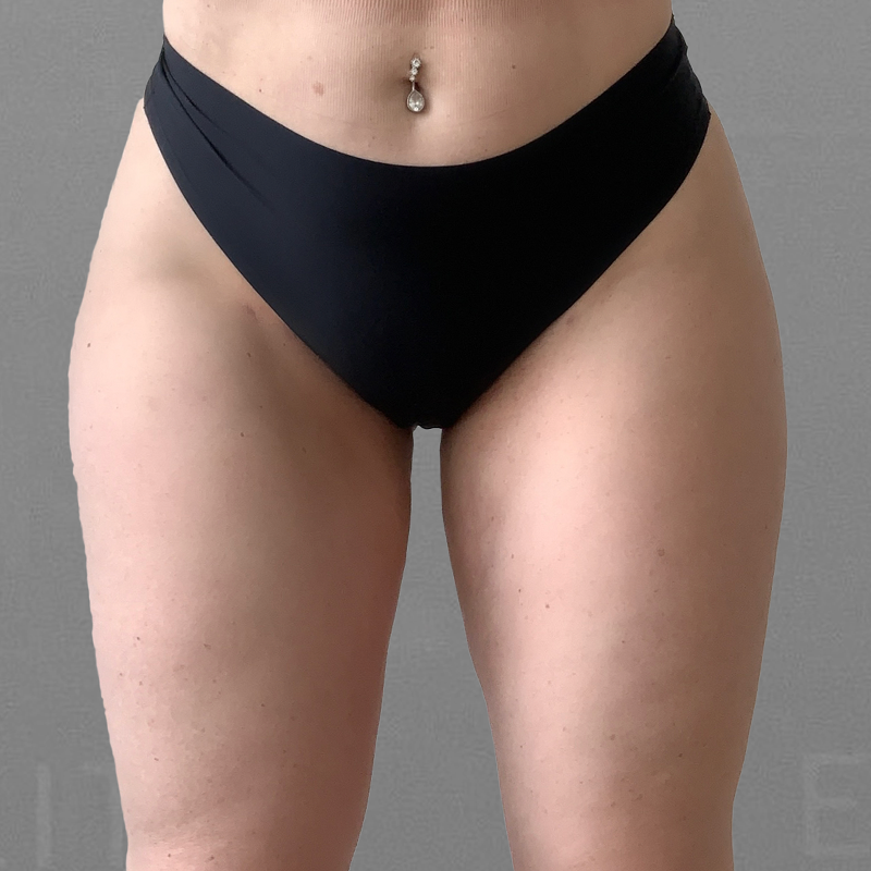leg airsculpt after