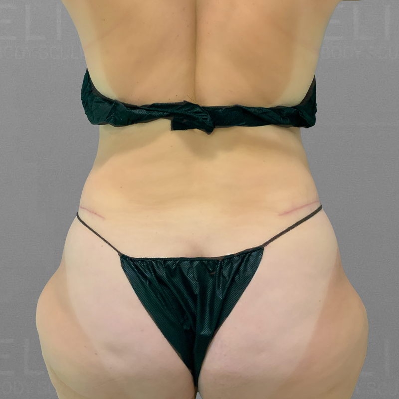 leg airsculpt before
