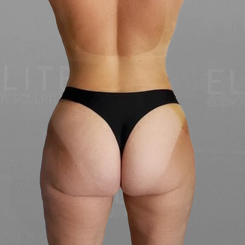 leg airsculpt after