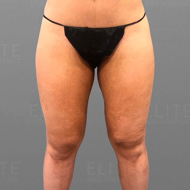 leg airsculpt before
