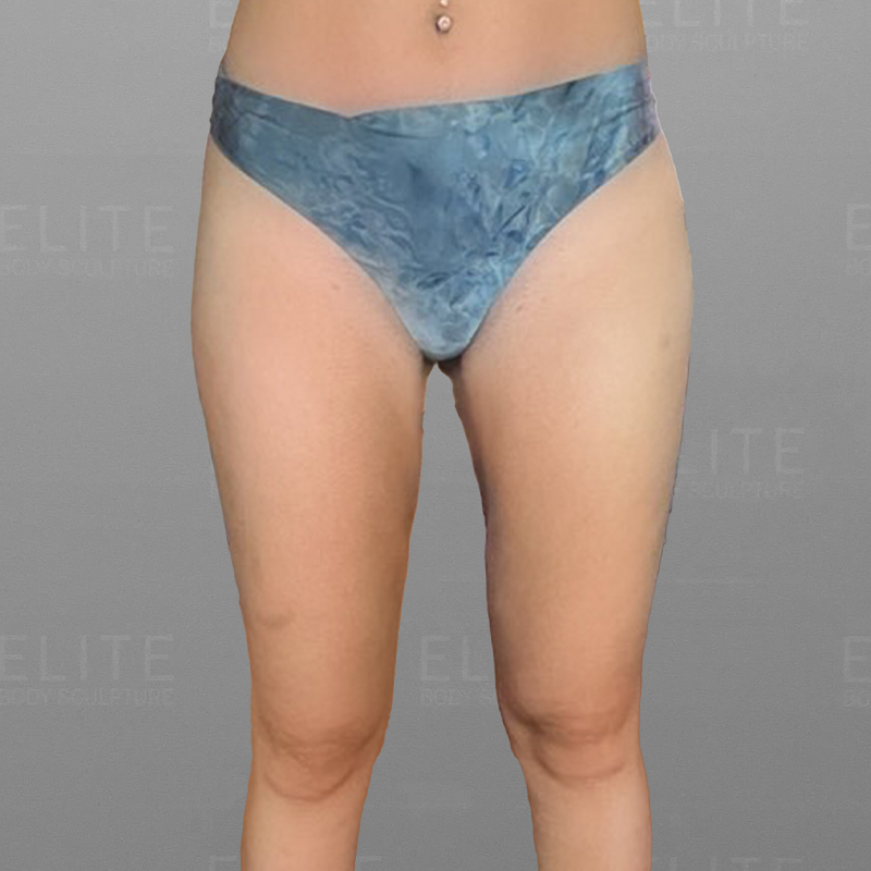 leg airsculpt after