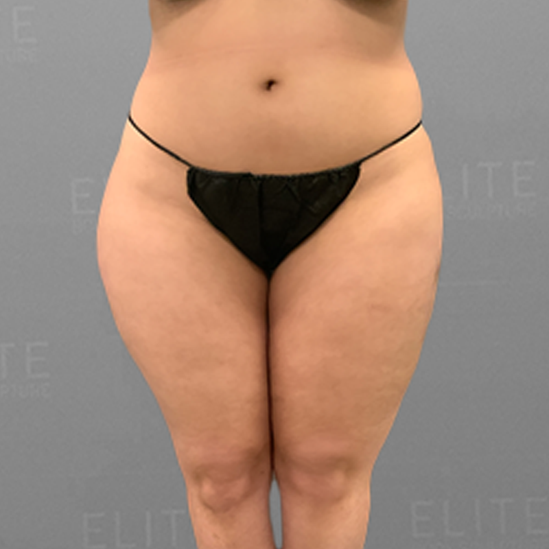 leg airsculpt before