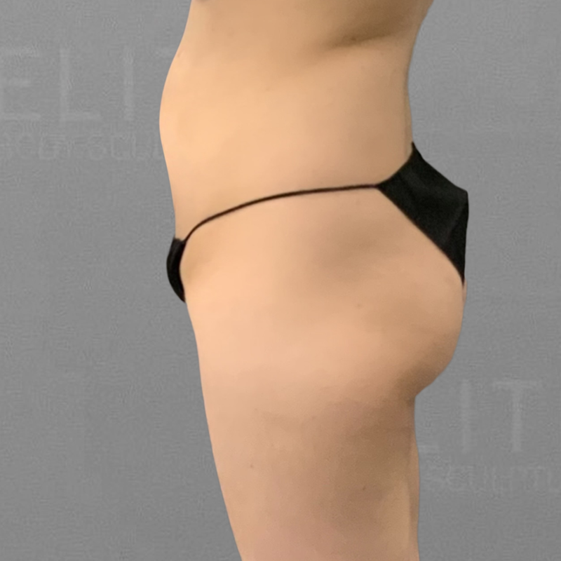 pubic airsculpt before shot