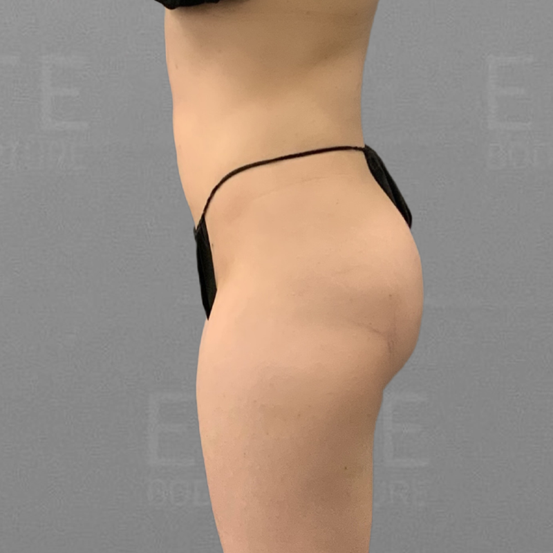 pubic airsculpt after shot