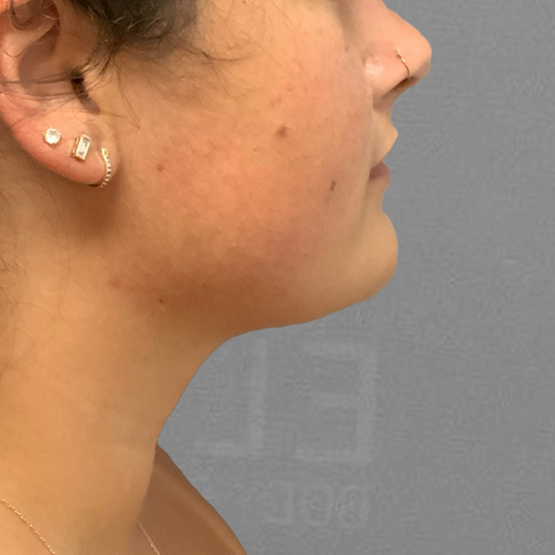 Chin fat removal