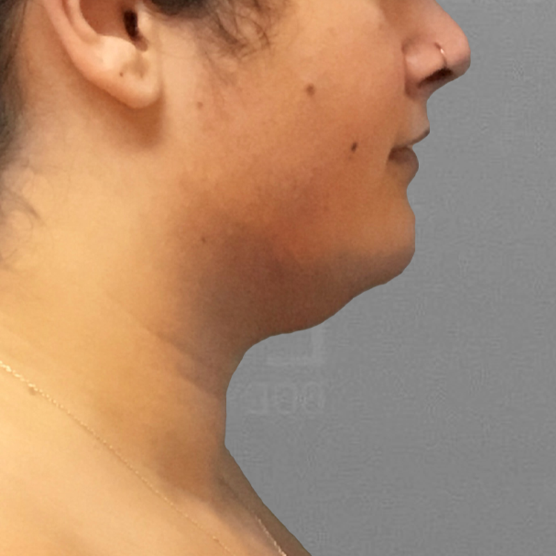 submental fat removal airsculpt