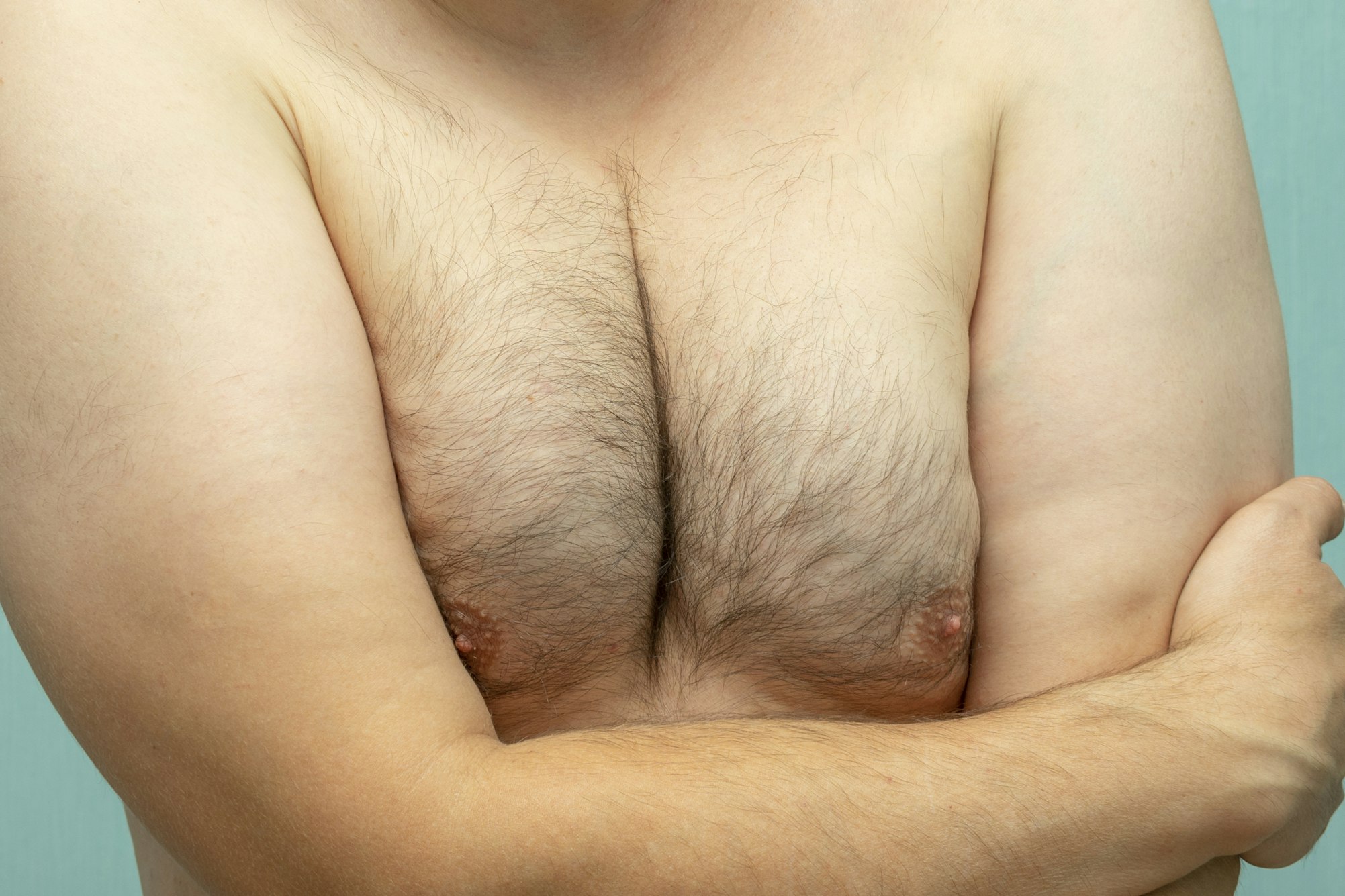 AirSculpt® Male Breast Reduction: Atlanta's Best Gynecomastia Surgery