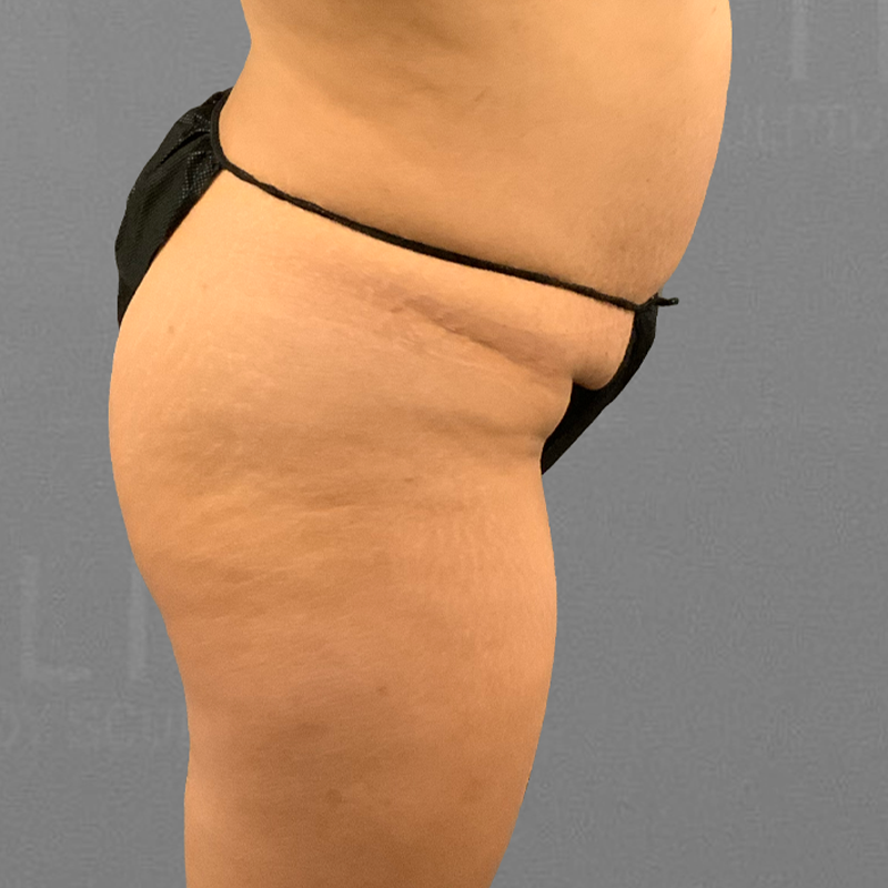 Before pubic airsculpt 