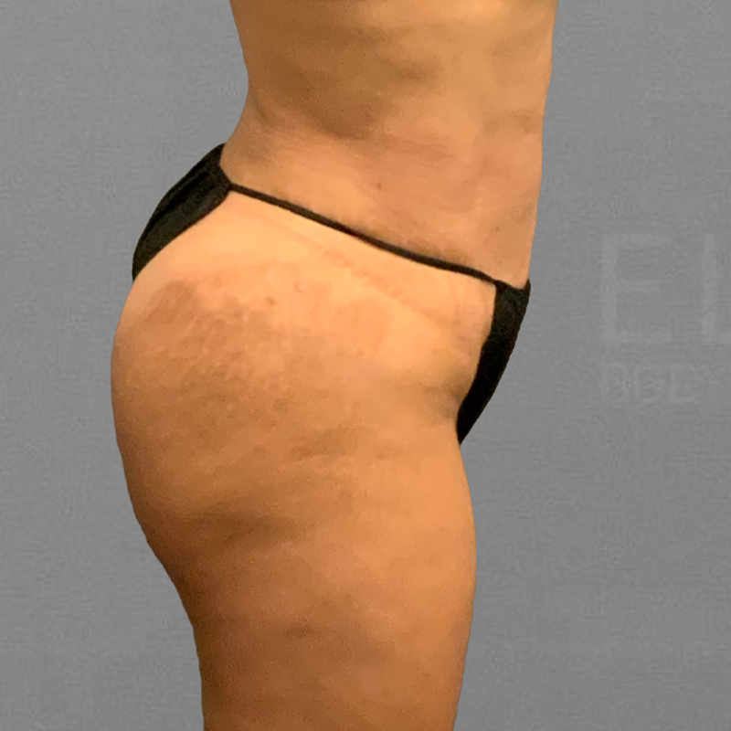 Lipo 360, Mons Pubis w/ Excision, Before and After