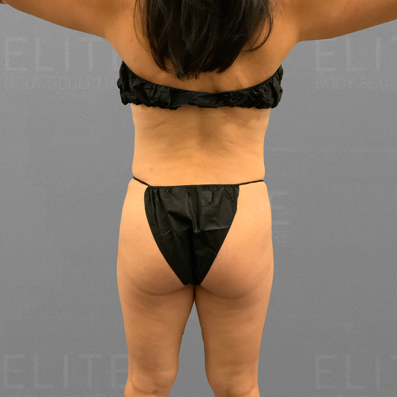 before airsculpt power bbl