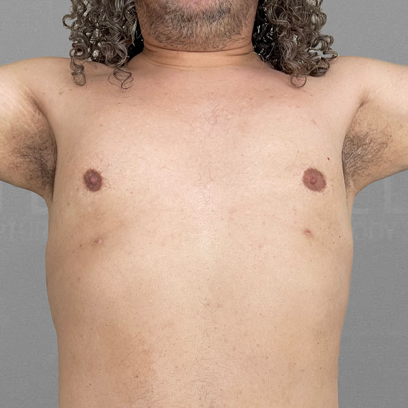 After AirSculpt male breast reduction
