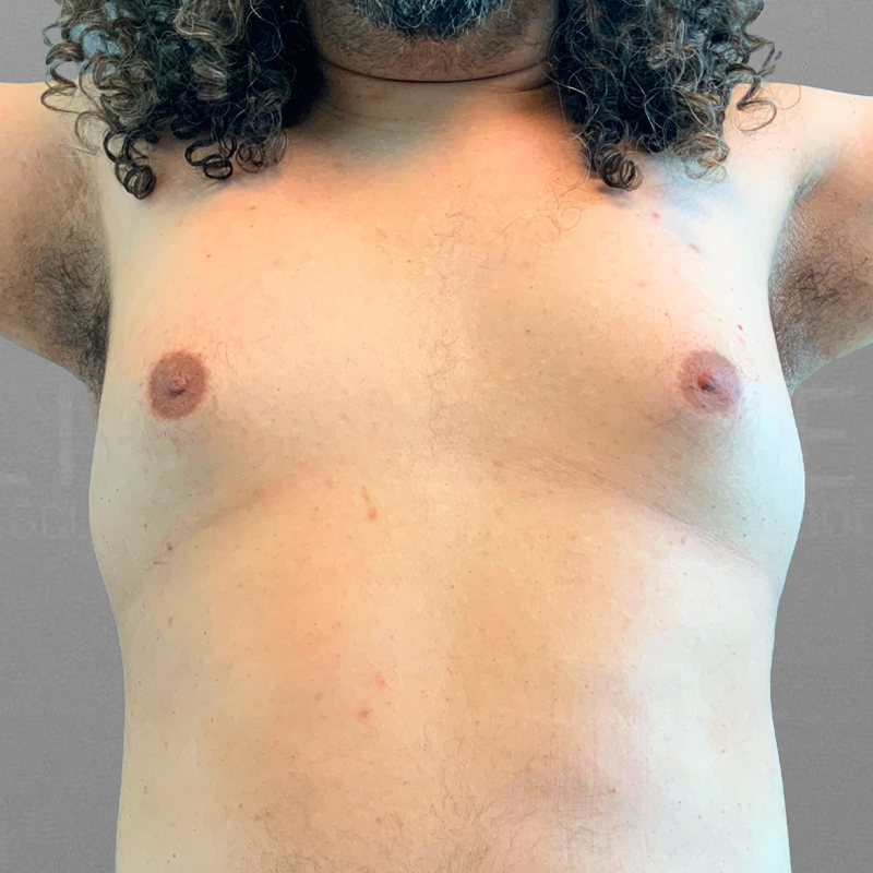 Before AirSculpt male breast reduction