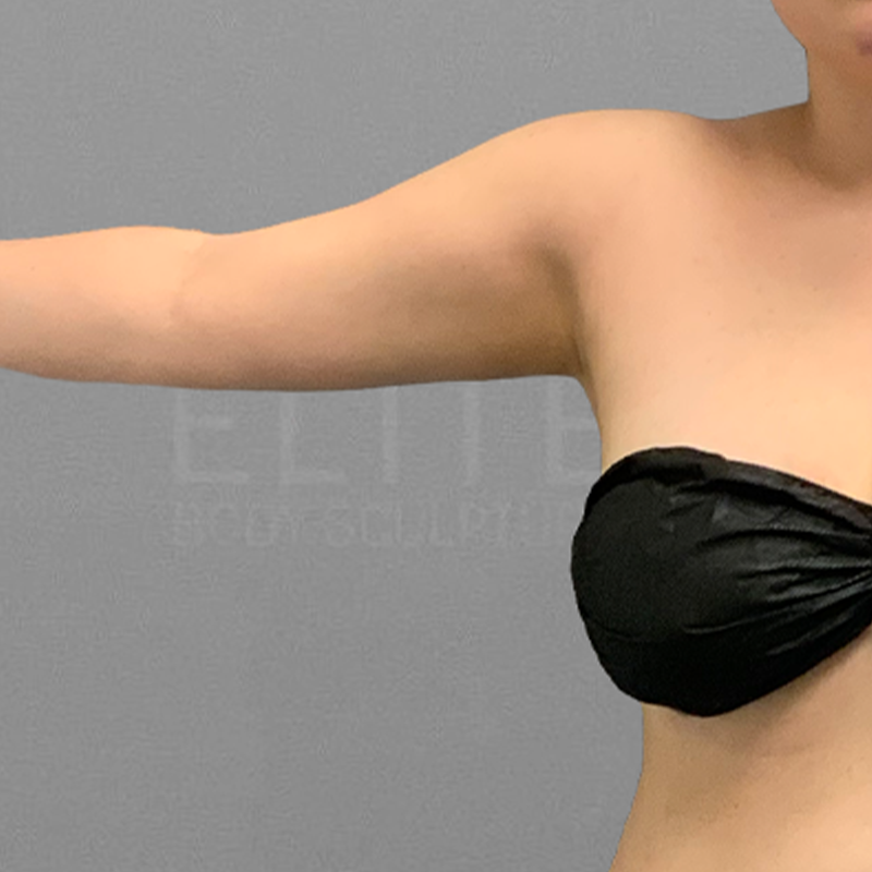 AirSculpt arm fat removal