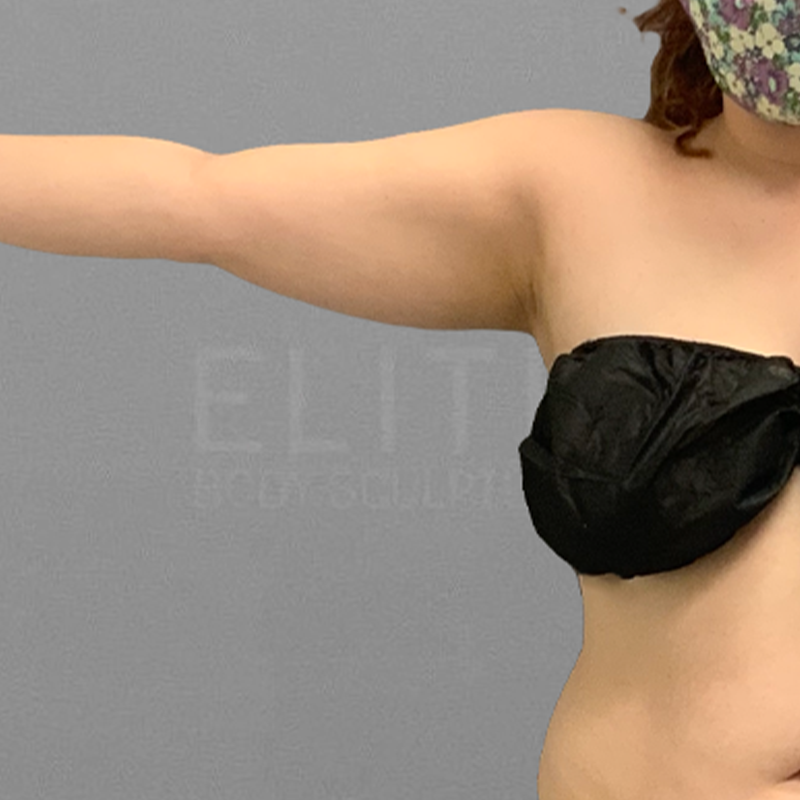 Before airsculpt arm fat removal