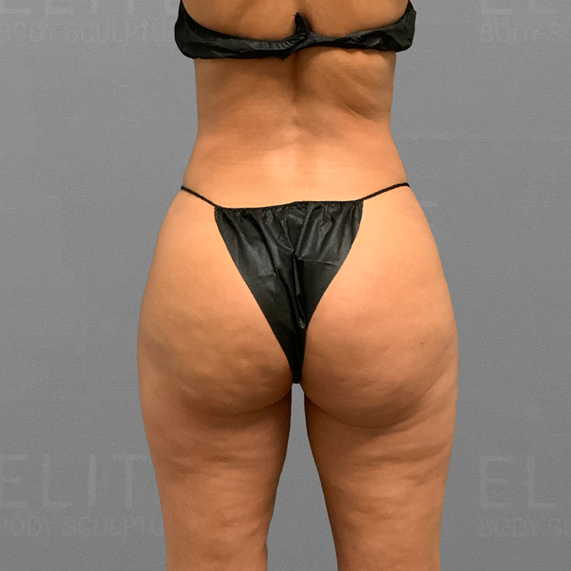after inner thigh airsculpt