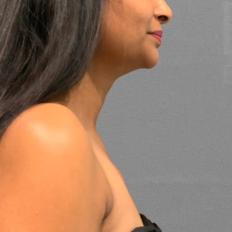 after chin airsculpt