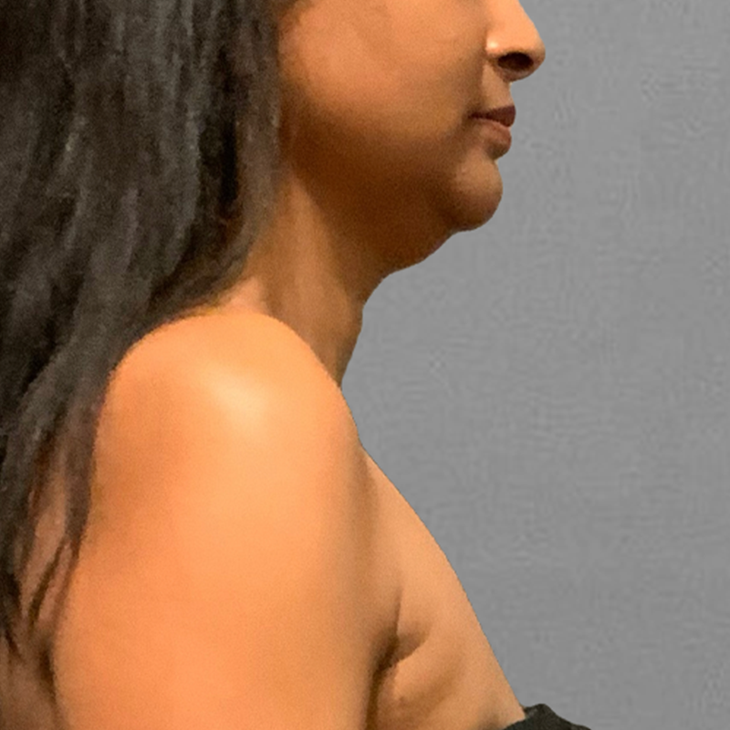 before chin airsculpt