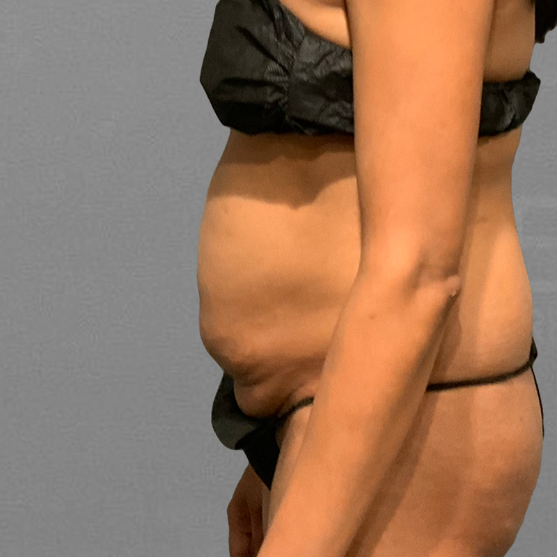 before pubic airsculpt